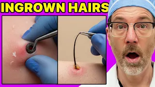 Plastic Surgeon Reacts to EXTREME Ingrown Hair Pulls