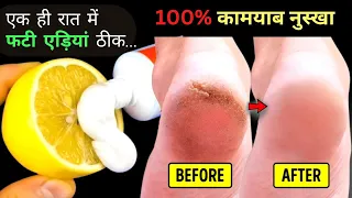 कितनी भी फटी ऐढ़ियाँ हों 1 ही रात में फटी एड़ियों से छुटकारा | Cracked Heels Home Remedy