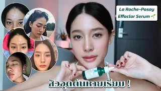 ใช้หมดใช้จริง! ที่สุดของเซรั่มลดสิวอุดตันLaroche Posay Effaclar Serum✨ | widpim withpim