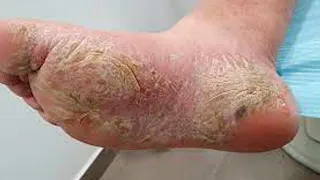 Hongos e infecciones en la planta de los pies