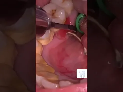 Sarro Dental acumulado por años 😯 #shorts