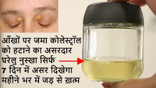 आंखो के कोलेस्ट्रॉल से छुटकारा, Xanthelasma , Eye Cholesterol Home Remedies , Eye Cholesterol remove
