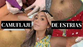 CAMUFLAJE DE ESTRIAS, VALE LA PENA, DUELE, COMO SE VE 3 AÑOS DESPUES - Ydelays