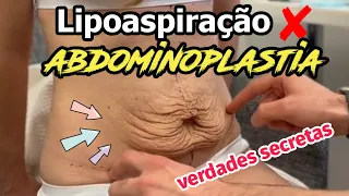 ABDOMINOPLASTIA ou LIPO ?? Verdades SECRETAS que ninguém conta...