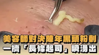 美容師對決陳年黑頭粉刺　一擠「長條起司」瞬湧出｜#全民話燒