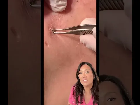 Satisfying Blackhead Removal You Have To See!