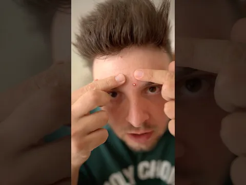 Огромна пъпка на челото на Стан