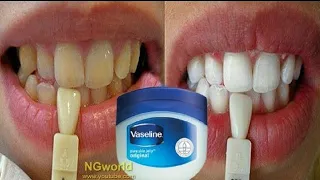 This recipe will lighten dirty yellow teeth like pearl in just 2 minutes  Dental home treatment