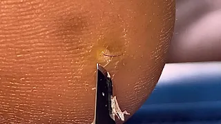 Hair splinter on heel #shortvideo