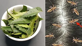 आधे घण्टे में : सर की जूं और लीख से छुटकारा पाने का घरेलू उपाय | Lice and Nits removal home remedy