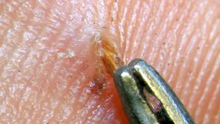 A SPLINTER INSIDE HUMAN SKIN UNDER A MICROSCOPE