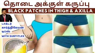 தொடை அக்குள் கழுத்து கருமை வெள்ளையாக மாற|dark skin spots black patches removal home remedies karthik