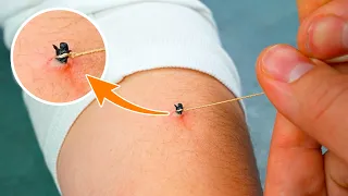 He Pulled THIS Out of His SKIN | DON’T Try This at Home!