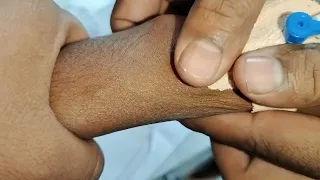 Cannulation.. long video.. part 08 #vigo