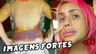 PRIMEIRA SEMANA DA CIRURGIA, Desvio de Septo e Lipo - Mandy Candy