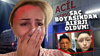 EN CİDDİ ALERJİLERDEN BİRİ; KAFAM ŞİŞTİ!! SAÇ BOYASI !!