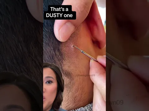 Terminal Hair in Scalp