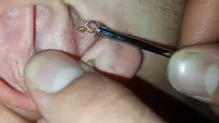 CLEANING OF HUGE BLACK DOTS and skin care asmr massage head massage