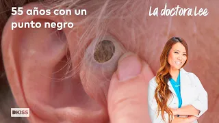 El punto negro más grande que ha extirpado la doctora Lee | La doctora Lee