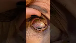 Doctor Removes 23 Contact Lenses From Patient's Eye