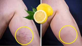 Lemon Removes Varicose Veins! Just Do This Every Day...