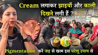 Jhaiya Khatam Karne Ka Tarika | Pigmentation Treatment at Home | Skincare Routine | Dr. Upasana