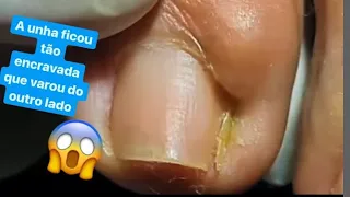 FICOU MUITOS ANOS SEM DESENCRAVAR A UNHA DEU NISSO 😷😱 Podologia Podologo Maurelio