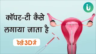 अनचाहा गर्भ रोकता है कॉपर-टी, क्या है ये, कैसे लगाया जाता है, देखें 3D में - Copper T (IUD) in Hindi