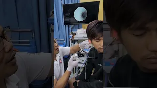 🔍 Endoscope Finds Secret Earwax Pocket! #earendoscopy #earcare #cleanear