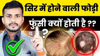 सिर में फोड़ी फुंसी (folliculitis)  क्यों होती है? जानिए इसका इलाज और उपाय || #mishraveda