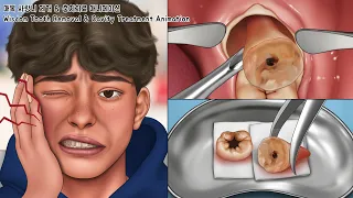 ASMR 매복 사랑니 제거 & 충치치료 풀버전! | 치아미백 | Wisdom Tooth & Cavity Treatment Animation