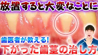 【歯茎下がり】下がった歯茎の治し方と対処法を歯医者が解説