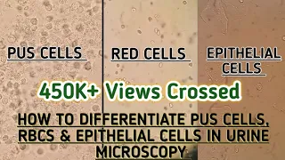 Pus cells,Red blood cells & Epithelial cells seen in urine microscopy.How to differentiate between.
