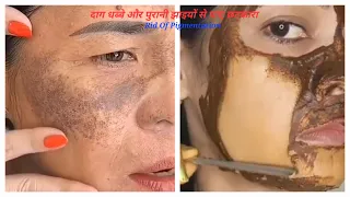 Remove Dark Spots & Pigmentation In 7 Days || सिर्फ 7 दिनों में पायें दाग-धब्बे और झाइयों छुटकारा 😍