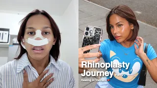 RHINOPLASTY JOURNEY (PART 2) | AWRA BRIGUELA