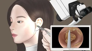 [ASMR] 편안한 귀 청소 / 대왕 귀지 제거 /Ear cleaning and Big ear wax removal