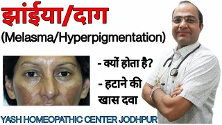 Melasma Hyperpigmentation treatment |चेहरे पर झाँईंया  दाग धब्बे का घरेलू होमीओपैथिक ईलाज
