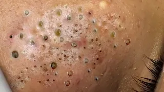 ニョキニョキ角栓/スポスポ角栓除去/𝐫𝐞𝐥𝐚𝐱/𝐒𝐚𝐭𝐢𝐬𝐟𝐲𝐢𝐧𝐠/𝐧𝐨𝐬𝐞 𝐛𝐥𝐚𝐜𝐤𝐡𝐞𝐚𝐝𝐬/𝐭𝐰𝐞𝐞𝐳𝐞𝐫𝐬/𝐚𝐜𝐧𝐞 𝐭𝐫𝐞𝐚𝐭𝐦𝐞𝐧𝐭/ピンセット/피지제거𝐍𝐨.32