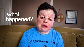 "My Brothers Set Me on Fire"  | Terry's Powerful Story
