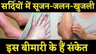 सर्दियों में सूजन, जलन और खुजली होने पर हो जाए सावधान ! INDIA NEWS VIRAL