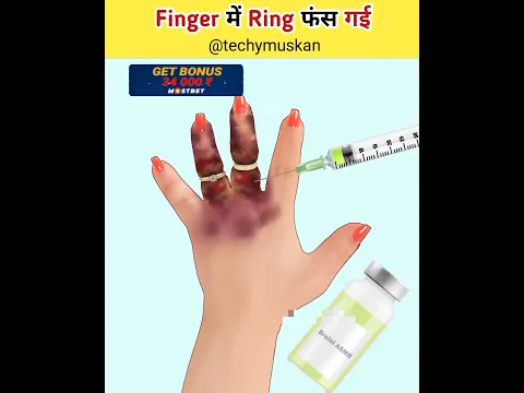 Finger में Ring फंस गई 😲 #asmr #shorts