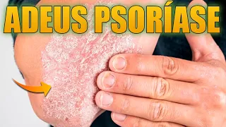 SE VOCÊ TEM PSORÍASE, ALERGIAS DE PELE, COCEIRAS E ESTRIAS, ESSA ERVA MEDICINAL PODE MUDAR SUA VIDA