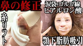 【整形手術】覚悟がある人だけ見てください。【鼻修正／顎下脂肪吸引／糸リフト／ヒアルロン酸】