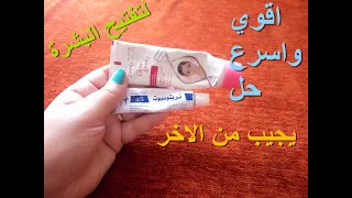 الخلطة الثلاثية للتفتيح علاج البقع البنية و اثار الحبوب و الكلف كريم تريتوسبوت وفير اند لفلي