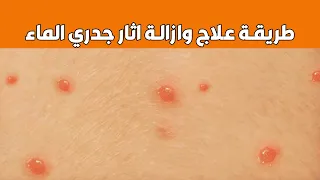طريقة علاج وازاله اثار جدري الماء عند الاطفال والكبار