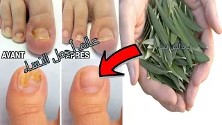 أوراق الزيتون كنز جعله الله لعلاج فطريات الأظافر ستعود كما كانت وصفة تغنيك عن طبيب أريد فقط دعوة خير