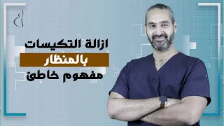 ازالة التكيسات بالمنظار مفهوم خاطئ