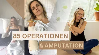 Amputation: 85 Operationen überlebt | Meine Geschichte #crps