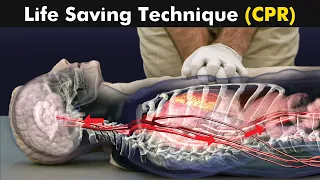 How cardiopulmonary resuscitation (CPR) is performed? (Urdu/Hindi)