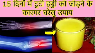 15 दिनों में टूटी हड्डी को जोड़ने के कारगर घरेलु उपाय | Fracture Bones Treatment